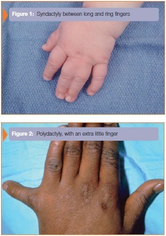 Which finger is called the ring finger? - Quora
