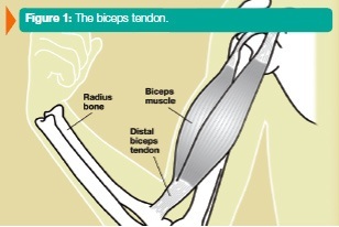 Distal Biceps Tendon Problems Manhattan New York