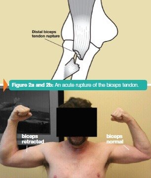 Torn discount bicep tendon