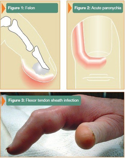 Toenail infection & fingernail infection | Raising Children Network