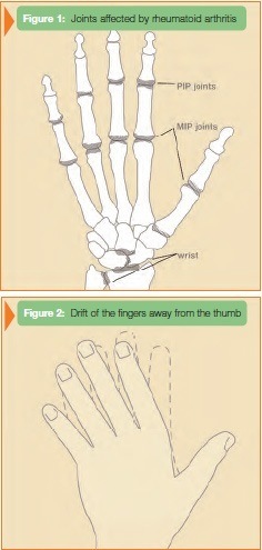 Adaptive Tools for Arthritis-Afflicted Hands