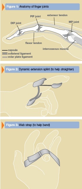 Common Causes of Finger Stiffness - The Orthopaedic Institute